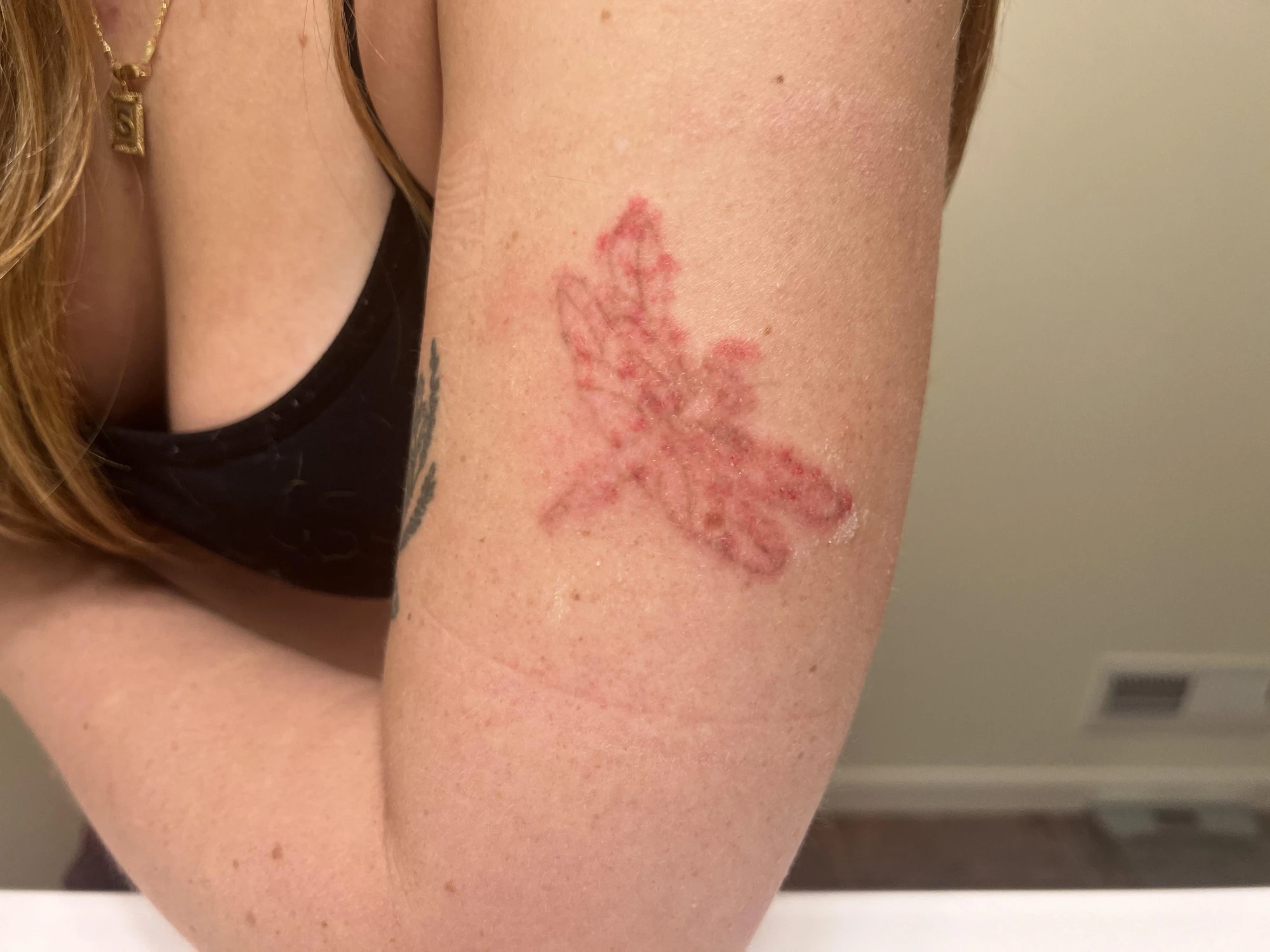 Blistering on upper arm after a laser tattoo removal session