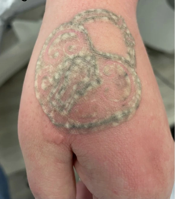 Frosting visible on a tattoo during a laser removal session