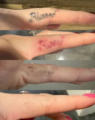Finger tattoo removal progression: before treatment, post-session healing, mid-treatment fading, and near-complete removal