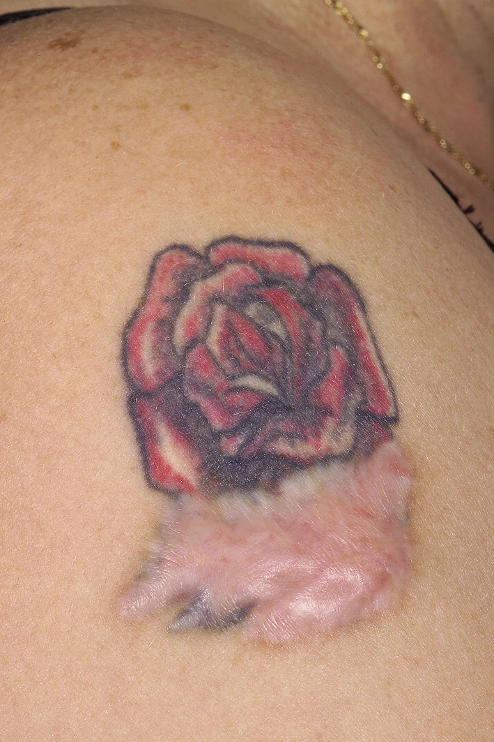 Hypertrophic scarring from tattoo removal — raised tissue below a rose tattoo on the shoulder