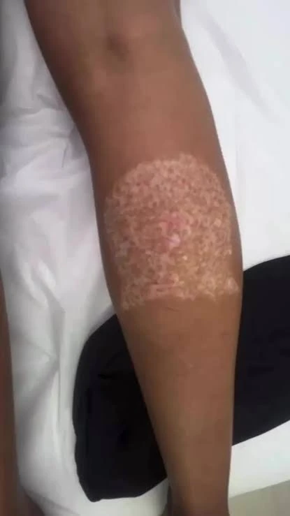 Hypopigmentation after laser tattoo removal — light patches on darker skin